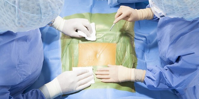 Due clinici si preparano ad incidere la pelle che è ricoperta da un telo impregnato di iodoforo
