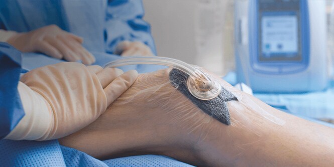 Medici che curano una ferita con la terapia Veraflo
