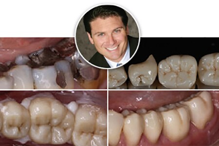 Zirconia monolitica applicata in un caso di ricostruzione senza modello di quattro unità
