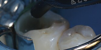 Filtek One Bulk Fill applicato nella cavità del dente

