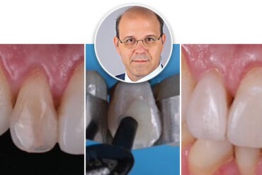 Anteprima delle foto del caso clinico del restauro

