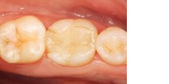 Inlay in vetroceramica al dente 46
