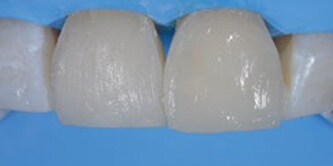 Risultato iniziale dopo il restauro del dente con il composito dentale
