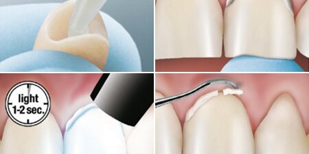 Guida dettagliata su 3M RelyX Unicem 2
