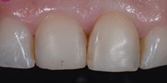 Il restauro in composito sugli incisori centrali mascellari deve essere sostituito.
