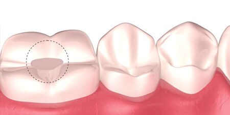 dente con un restauro
