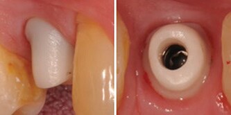 Situazione intraorale con il moncone in zirconia inserito.
