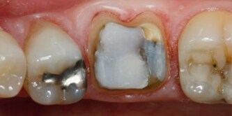 preparazione del dente
