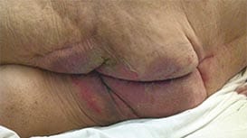 Dermatiti asscoiate all'incontinenza (IAD)
