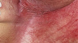 Intertrigine (ITD)
