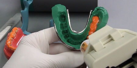 Tecnica di impronta 2-step
