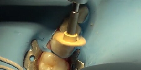 Anteprima video caso clinico di lucidatura
