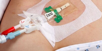 Soluzioni per gli accessi vascolari
