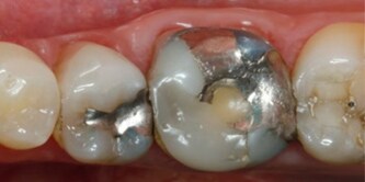 Situazione iniziale del dente
