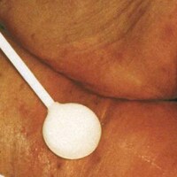 IAD, dermatite associata all'incontinenza