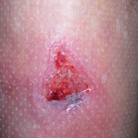 medicazione in schiuma