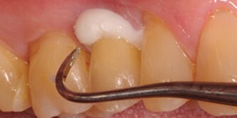 Dopo aver applicato il 3M Ketac Cem Plus Cemento composito vetroionomerico modificato
