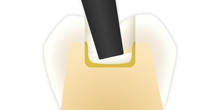 dente restaurato
