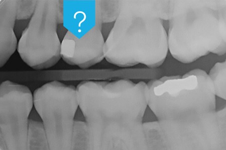 Radiografia dei denti che mostra la radiopacità degli adesivi dentali
