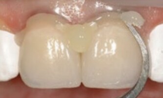 Inserire le corone dentali
