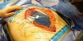 Terapia a pressione negativa per addome aperto
