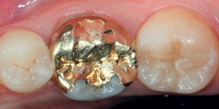 Corona fusa parziale in lega aurea insufficiente e perforata sul primo molare inferiore
