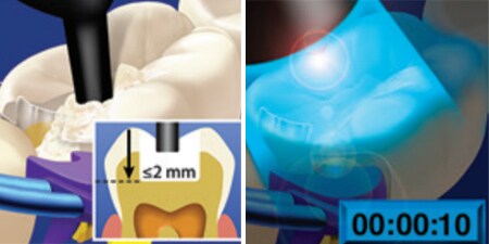 Guida alla tecnica 3M Filtek Universal
