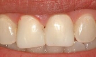 Denti provvisori dopo l'invio della scansione digitale al laboratorio.
