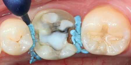 Controllo dell'umidità interprossimale del margine sottogengivale
