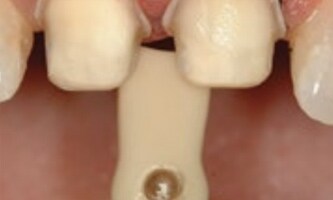 Denti preparati a chamfer e margine sopragengivale. Comunicare il colore della preparazione.

