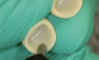 Come sabbiare un dente
