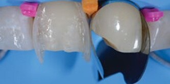 Dente ricostruito con 3M Filtek Universal
