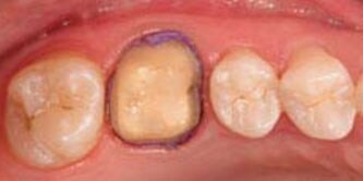 alt= Preparazione del dente 26, con fili di retrazione in posizione, vista occlusale
