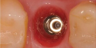 Il dente è stato estratto ed è stato inserito un impianto Straumann® Bone Level.
