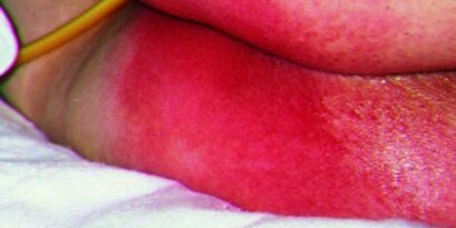 Dermatite associata all'incontinenza

