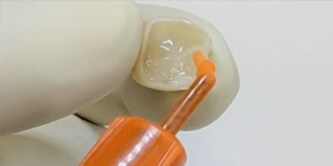 Applicazione del 3M™ RelyX™ Universal Cemento composito.

