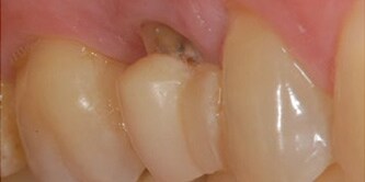 Situazione iniziale con il secondo premolare superiore che mostra una radice rotta.
