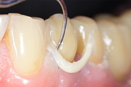 dente con cemento in eccesso che viene rimosso
