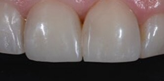 Risultato finale: il sorriso del paziente è stato ripristinato con risultati dall'aspetto naturale.
