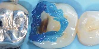 Il dente viene mordenzato mediante una tecnica selettiva di aggancio dello smalto.
