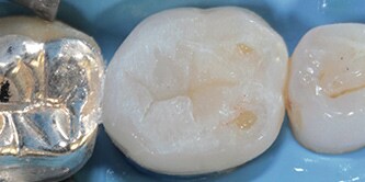 Dente appena restaurato
