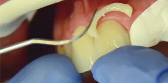 Semplice pulizia del materiale in eccesso su un dente
