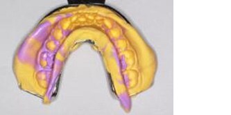 Impronta dentale
