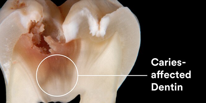 dentina affetta da carie
